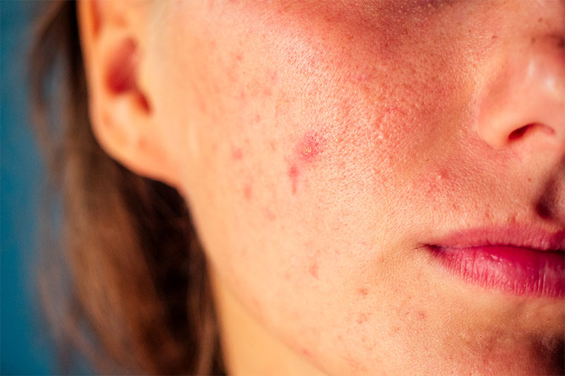 You Can End Up With Acne