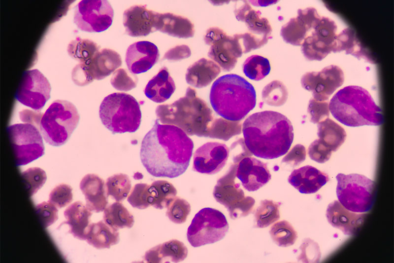 Chronic Myeloid Leukemia (CML)