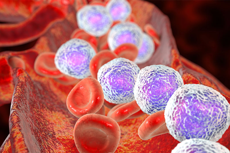 Acute Lymphocytic Leukemia (ALL)