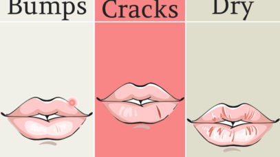 8 Things Your Lips are Trying to Tell You About Your Health