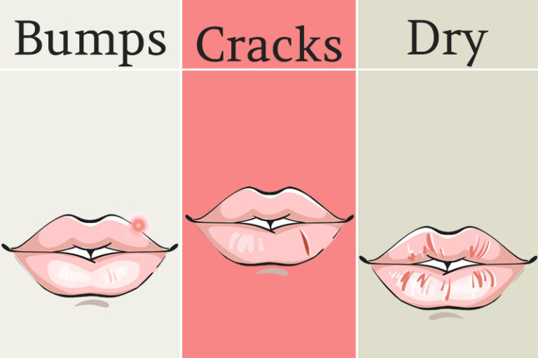 8 Things Your Lips are Trying to Tell You About Your Health Healthy