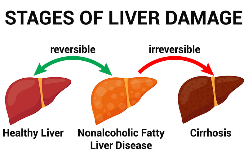 11 Warning Signs Of Nonalcoholic Fatty Liver Disease