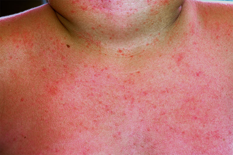 Heat Rash