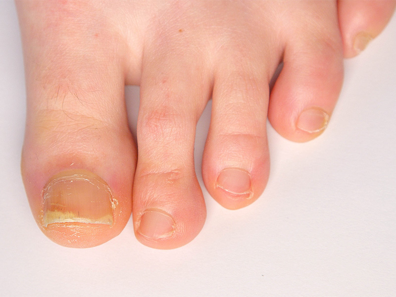 Pitted toenails