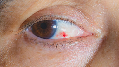 Reoccurring blood spots in your eye