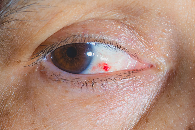 Reoccurring blood spots in your eye