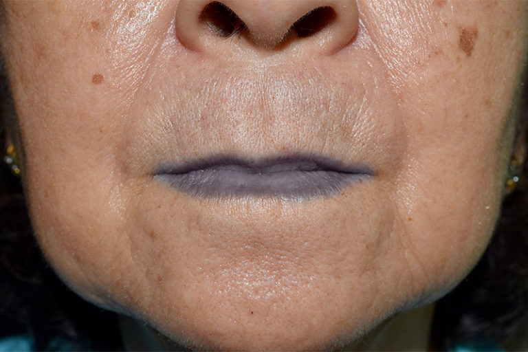 8 Things Your Lips are Trying to Tell You About Your Health Page 3 of