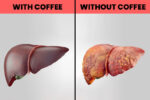 Drink more coffee for a healthy gallbladder