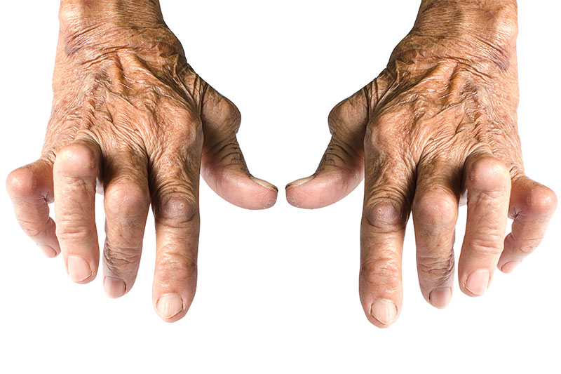 Rheumatoid Arthritis