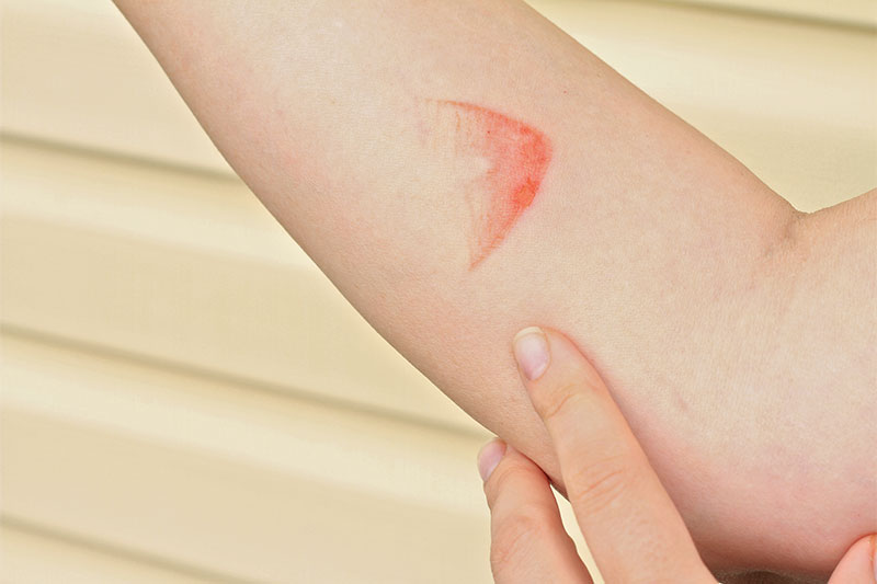 Prevent burn scars by pressing the pads of your fingers against the burnt skin