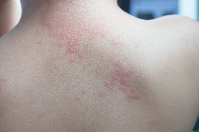 Hives That Are Chronic