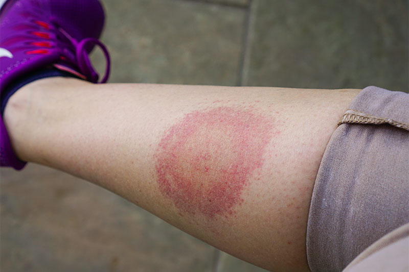 A rash in the shape of a bullseye