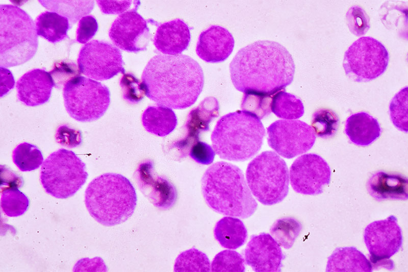 Acute Myeloid Leukemia (AML)