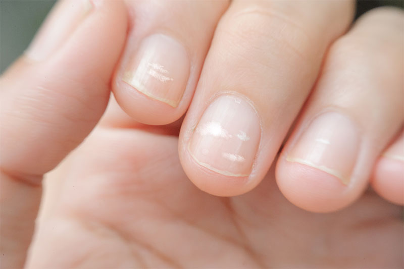 White spots on your nails